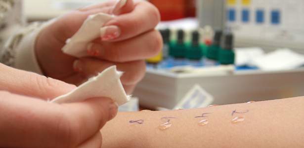 Bőrgyógyászati alkaros (prick) allergia tesztek